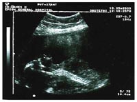 Ultrasound